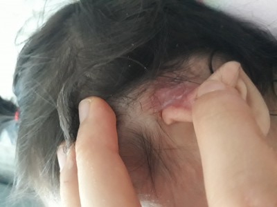 bebeklerde kulak arkasi yaralari