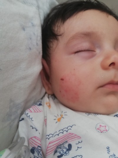 atopik dermatit nasil gecer 3 6 ay arasi bebekler