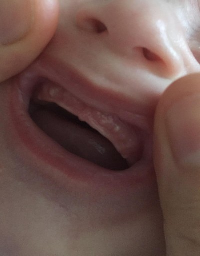 bebeklerde diş etinde beyaz nokta