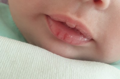 bebeklerde dudak catlamasina ne iyi gelir 3 6 ay arasi bebekler