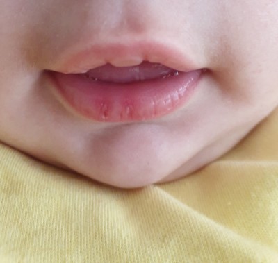 bebeklerde dudak catlamasina ne iyi gelir 3 6 ay arasi bebekler