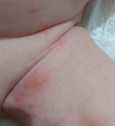 Bacak Arasinda Olusan Kizariklik Ve Sivilce Benzeri Kabarciklar Fotografli Yenidogan 0 3 Ay